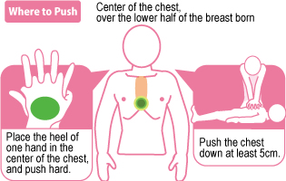 How to perform chest compressions